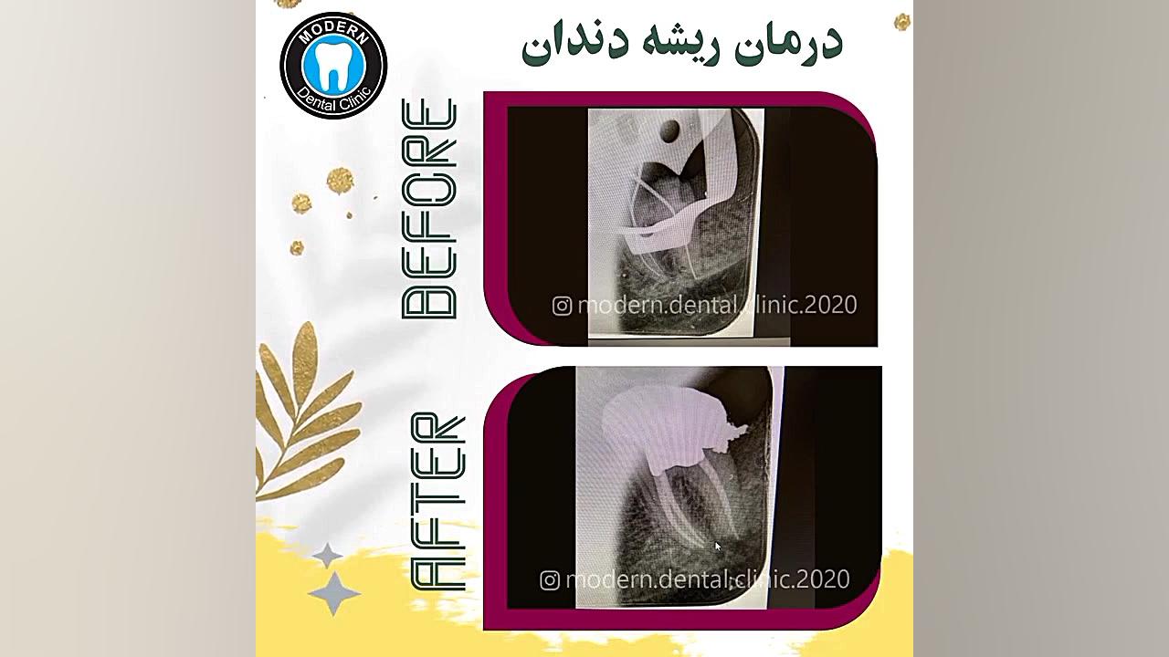درمان ریشه دندان سندرم نفروتیک ارثی