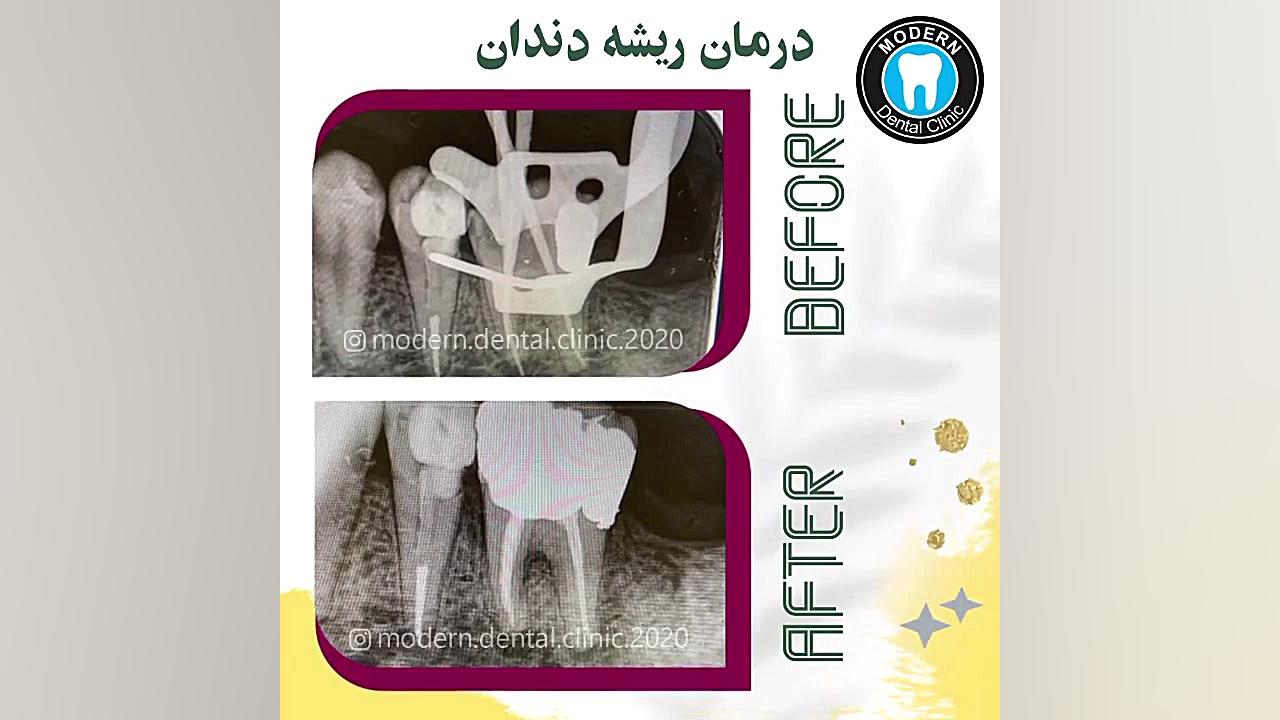 درمان ریشه دندان دندانپزشک زیبایی