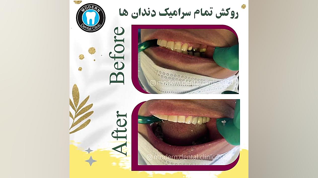روکش تمام سرامیک دندان ها لیپوست