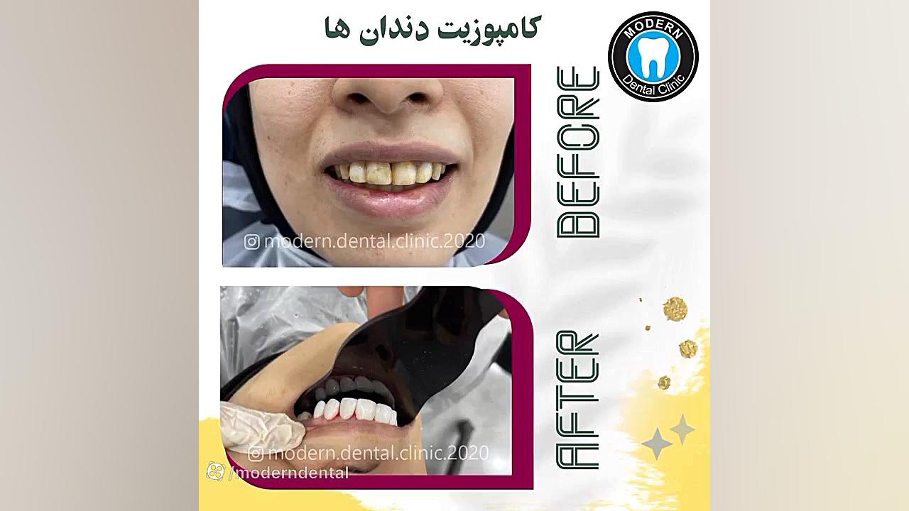 کامپوزیت دندان اصلاح طرح لبخند