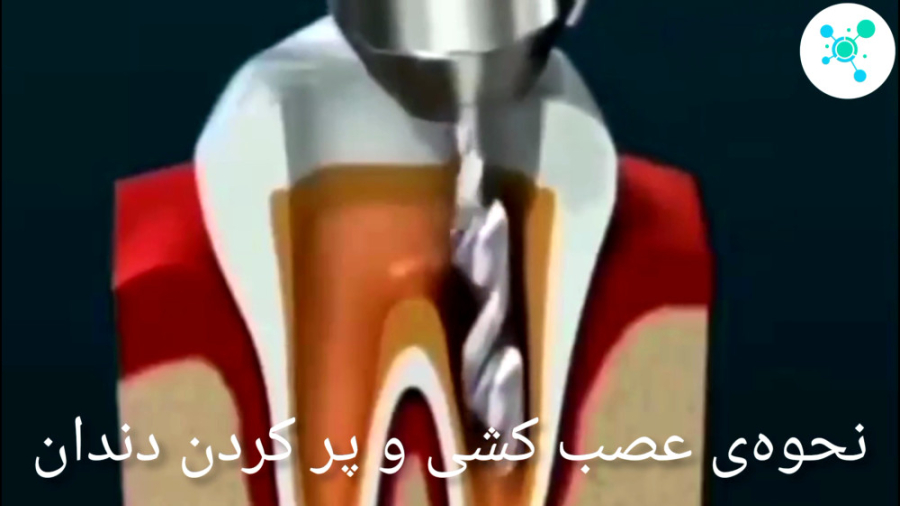 نحوه ی عصب کشی و پر کردن دندان (دیجی علم) هیدروراکس