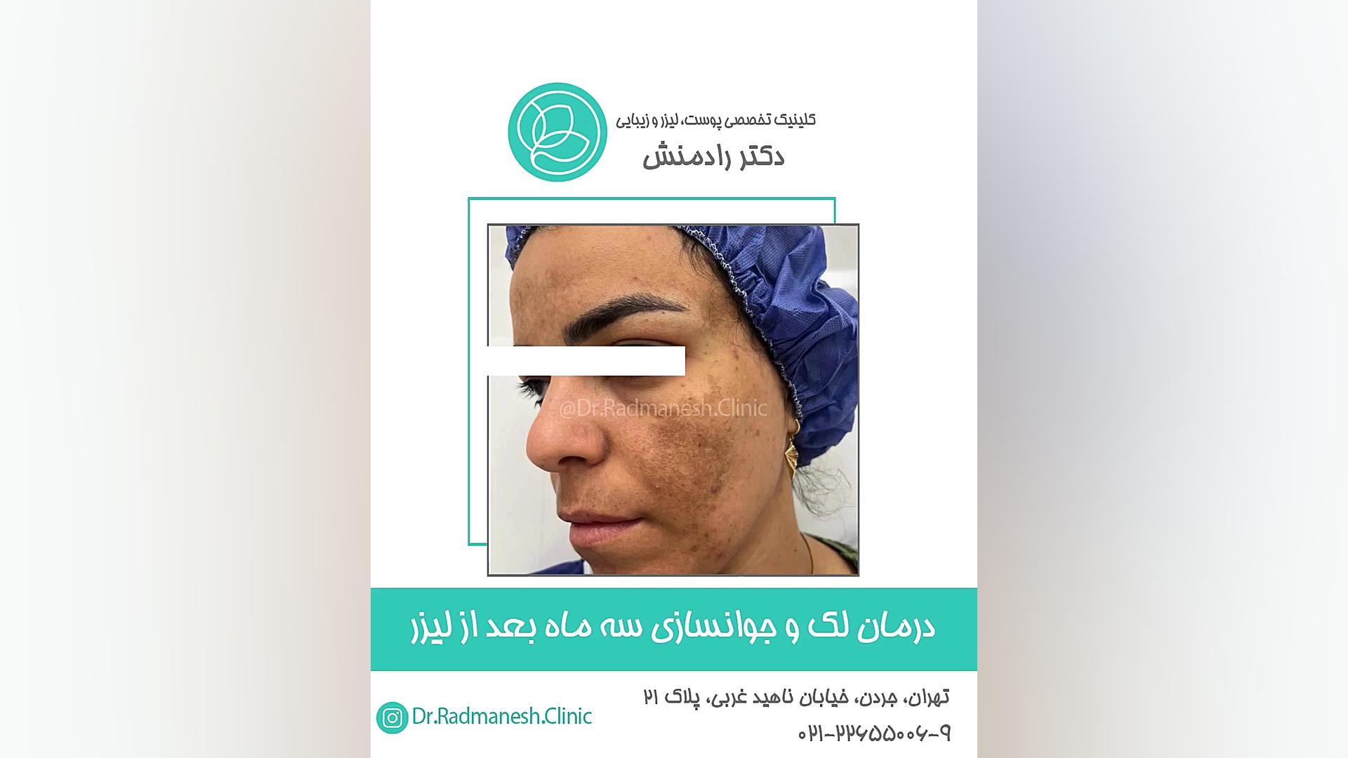 درمان لک و جوانسازی سه ماه بعد از لیزر رادیوگرافی دندان