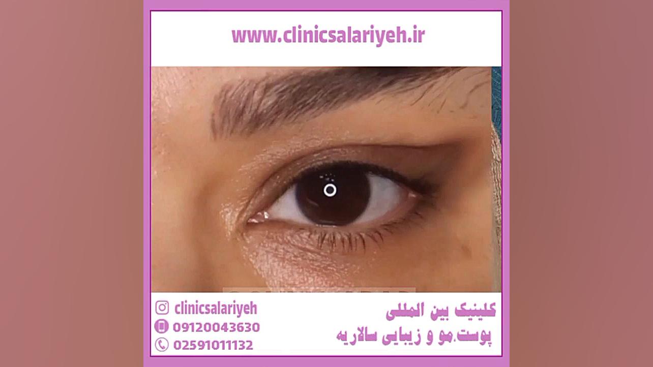 بهترین دکتر پوست برای لیفت ابرو بررسی اروماتاز