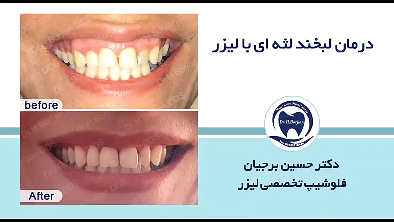 نمونه درمان لبخند لثه ای با لیزر (3) | بهترین جراح لثه اصفهان Screening Lentiviral Vector