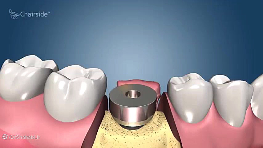 ایمپلنت دندان | DENTAL IMPLANTS RNA Interference Assay