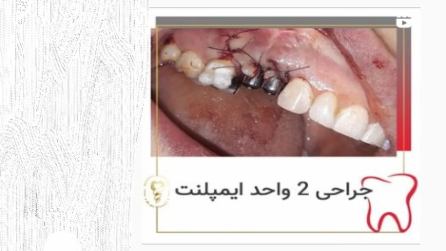 ️جراحی ۲ واحد ایمپلنت ️ دکتر علی قمری - متخصص جراحی لثه و ایمپلنت