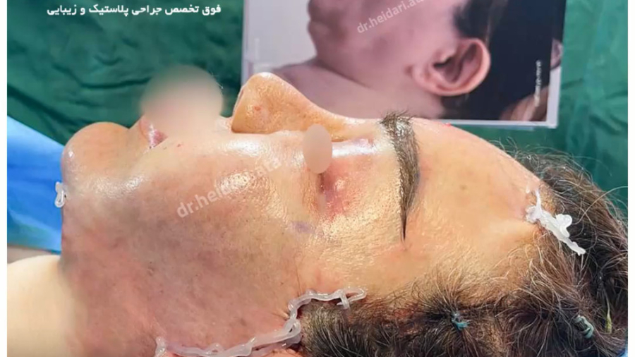 لیفت کامل صورت ، گردن و پیشانی PRO-Seq