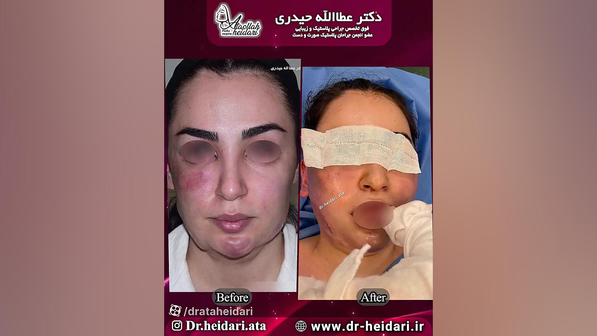 تخلیه ژل پاژ و لیفت صورت و گردن PRO-Seq