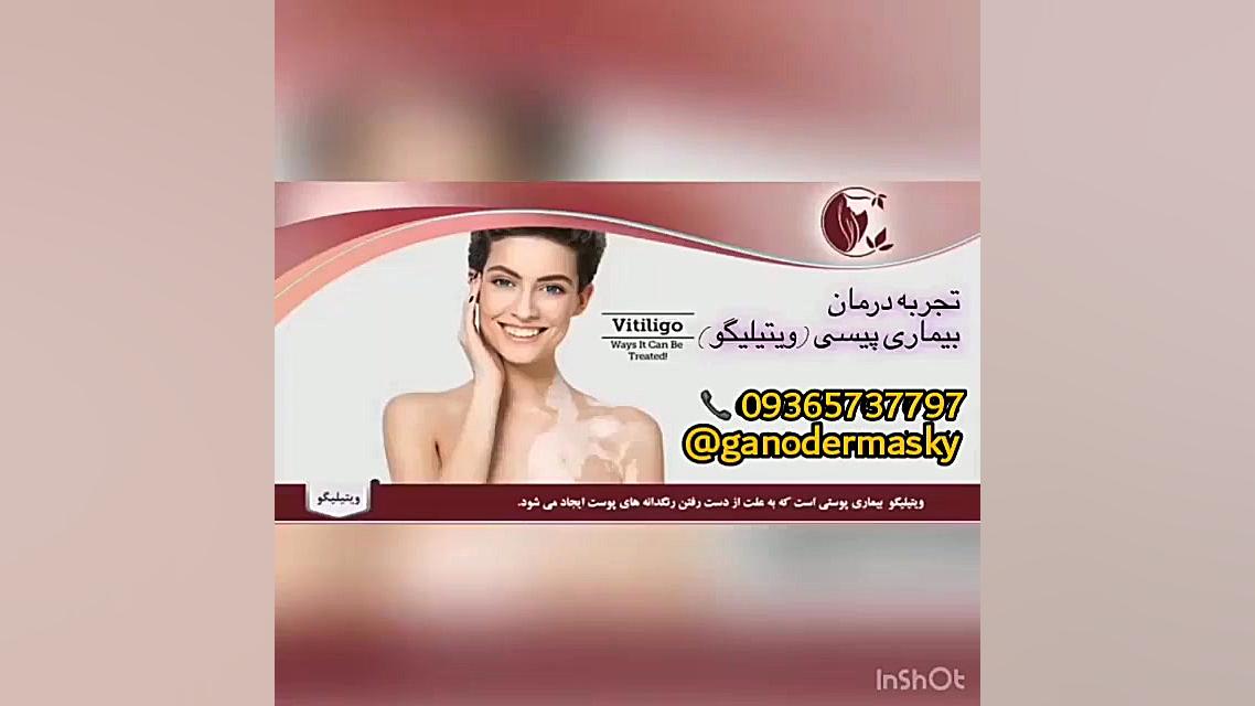 درمان لکه های پوستی ویتیلیگو(پیسی، برص، امراض جلدی) کشف شد.. اینسایزینگ