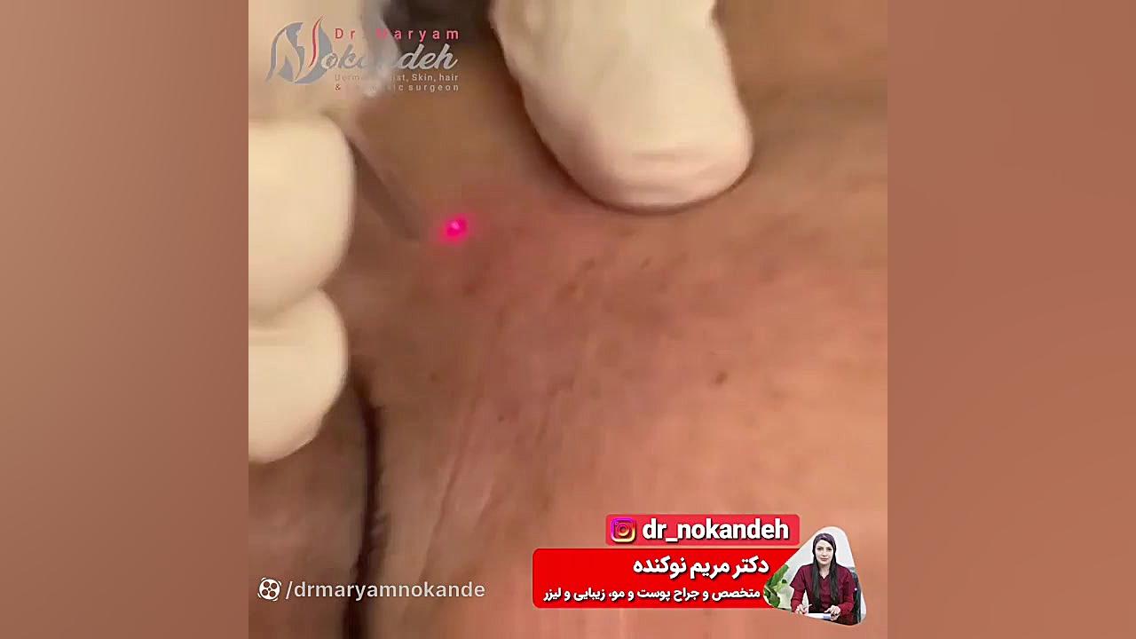 برداشتن خال در یک جلسه دکتر مریم نوکنده