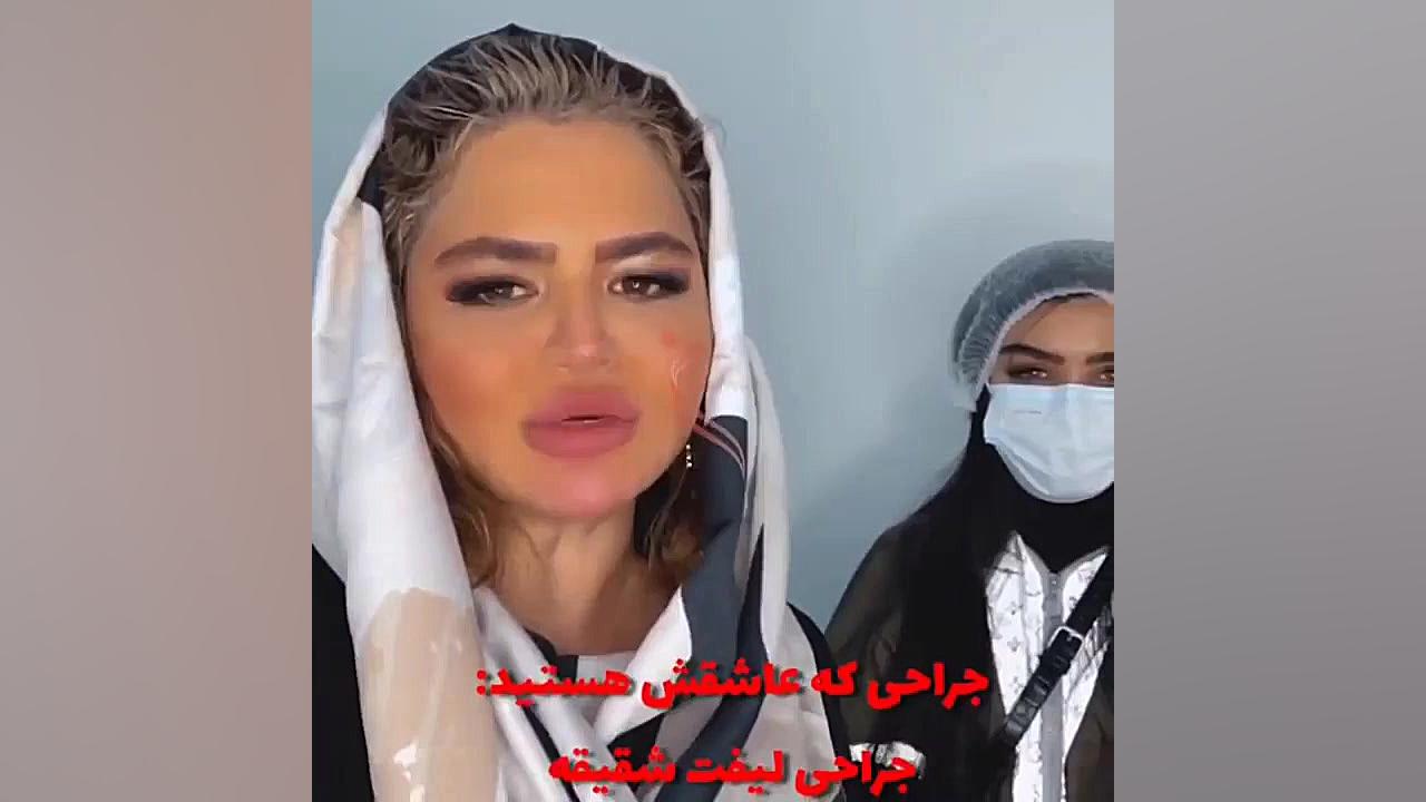 جراحی چشم گربه ای پلاستیک لثه