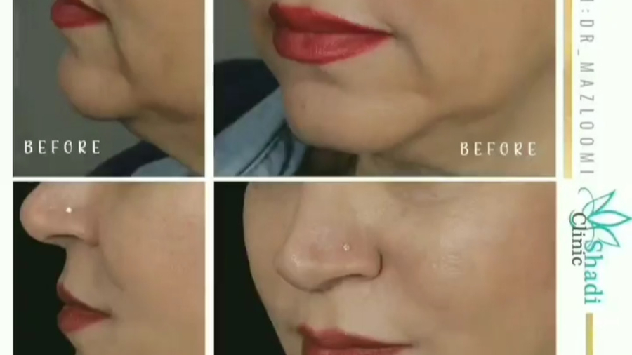 لیفت صورت با نخ یکی از اصلی ترین روش های غير تهاجمی جوانسازی پوست نپتوکلیب