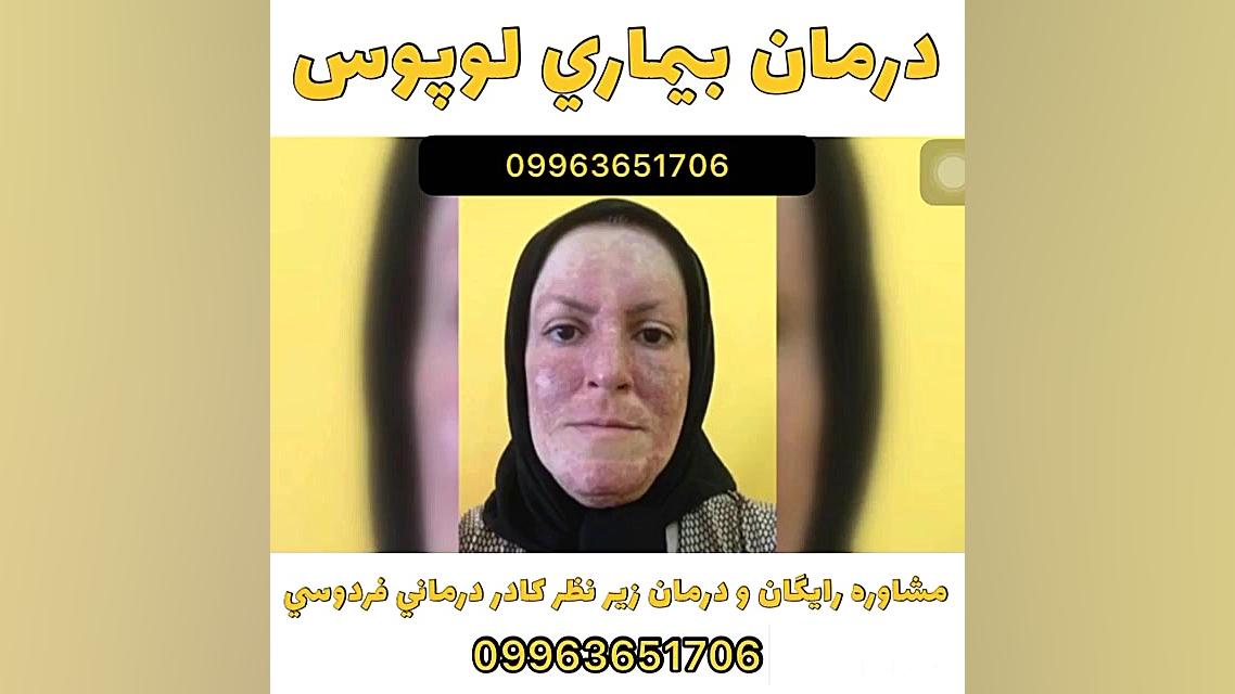 درمان گیاهی لوپوس پیدا شد! رفع چین و چروک