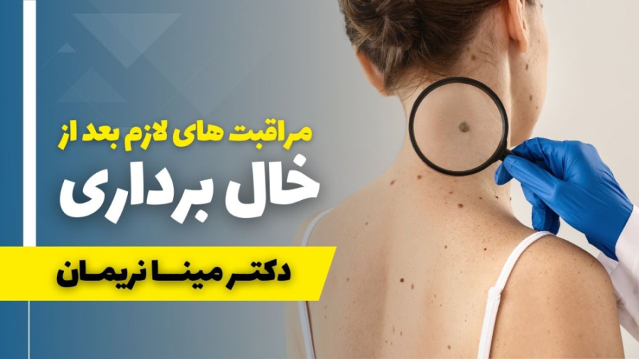 مراقبت های بعد از خال برداری توپلیزوماب