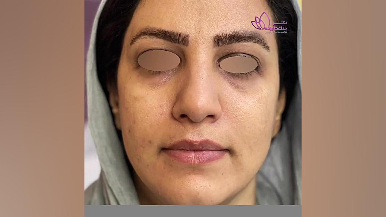 تزریق چربی برای زاویه سازی و کانتورینگ صورت رادیوگرافی دندان