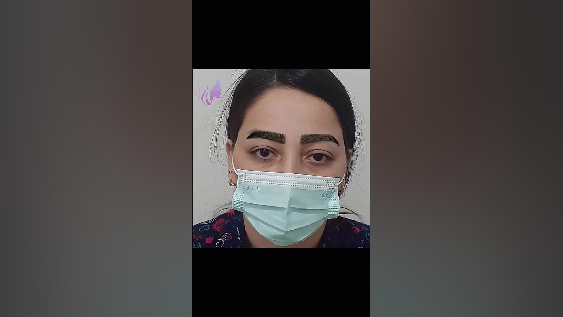 کاشت ابرو بدون درد به دلخواه مشتری دکتر صفیه چعباوی زاده