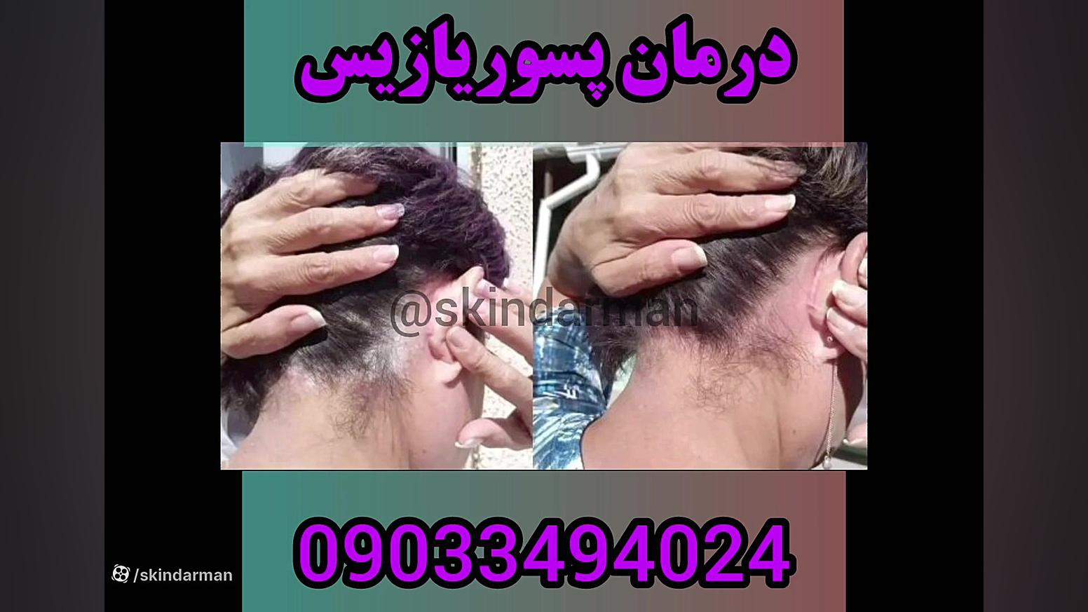 نمونه درمان پسوریازیس دندان مصنوعی