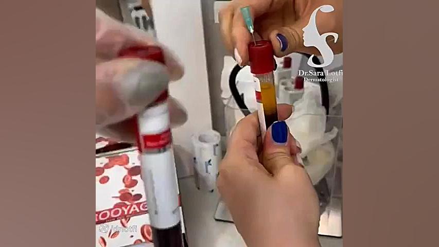 PRP دکتر سار ا لطفی