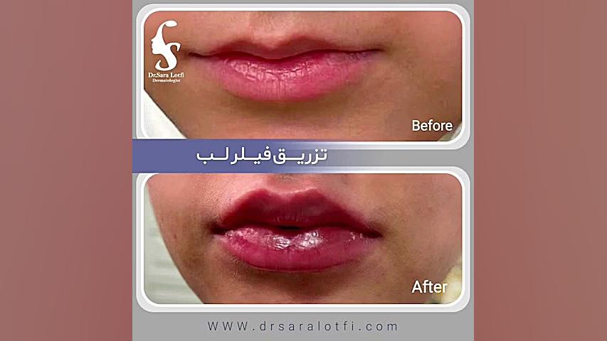 تزریق فیلر لب دکتر سار ا لطفی