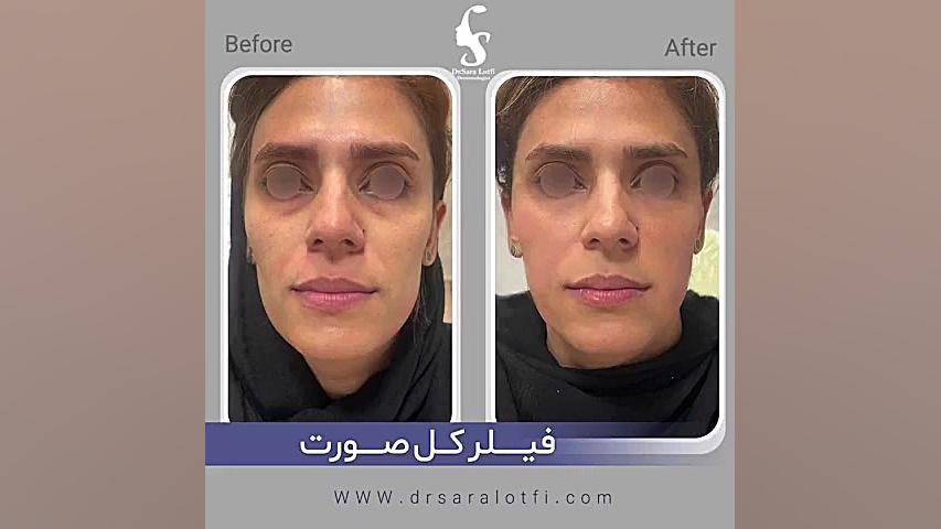 تزریق فیلر کل صورت دکتر سار ا لطفی