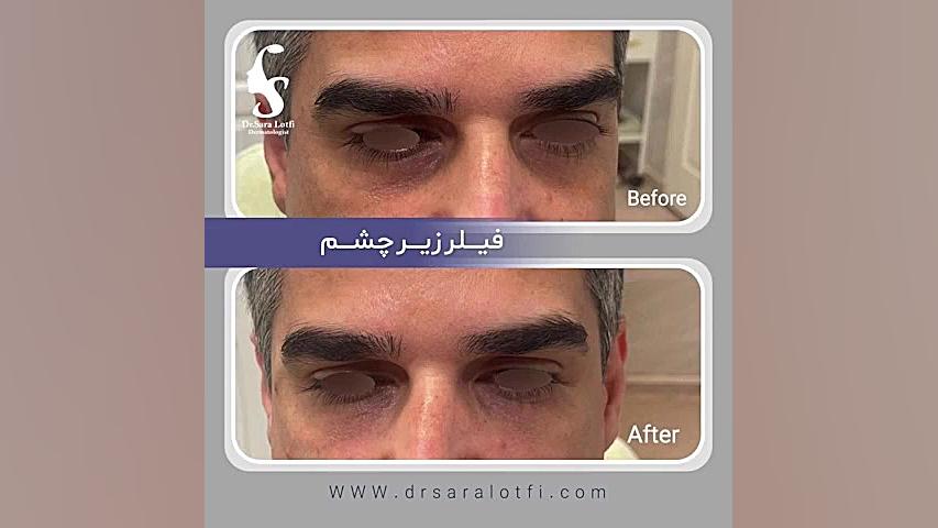 تزریق فیلر زیر چشم دکتر سار ا لطفی