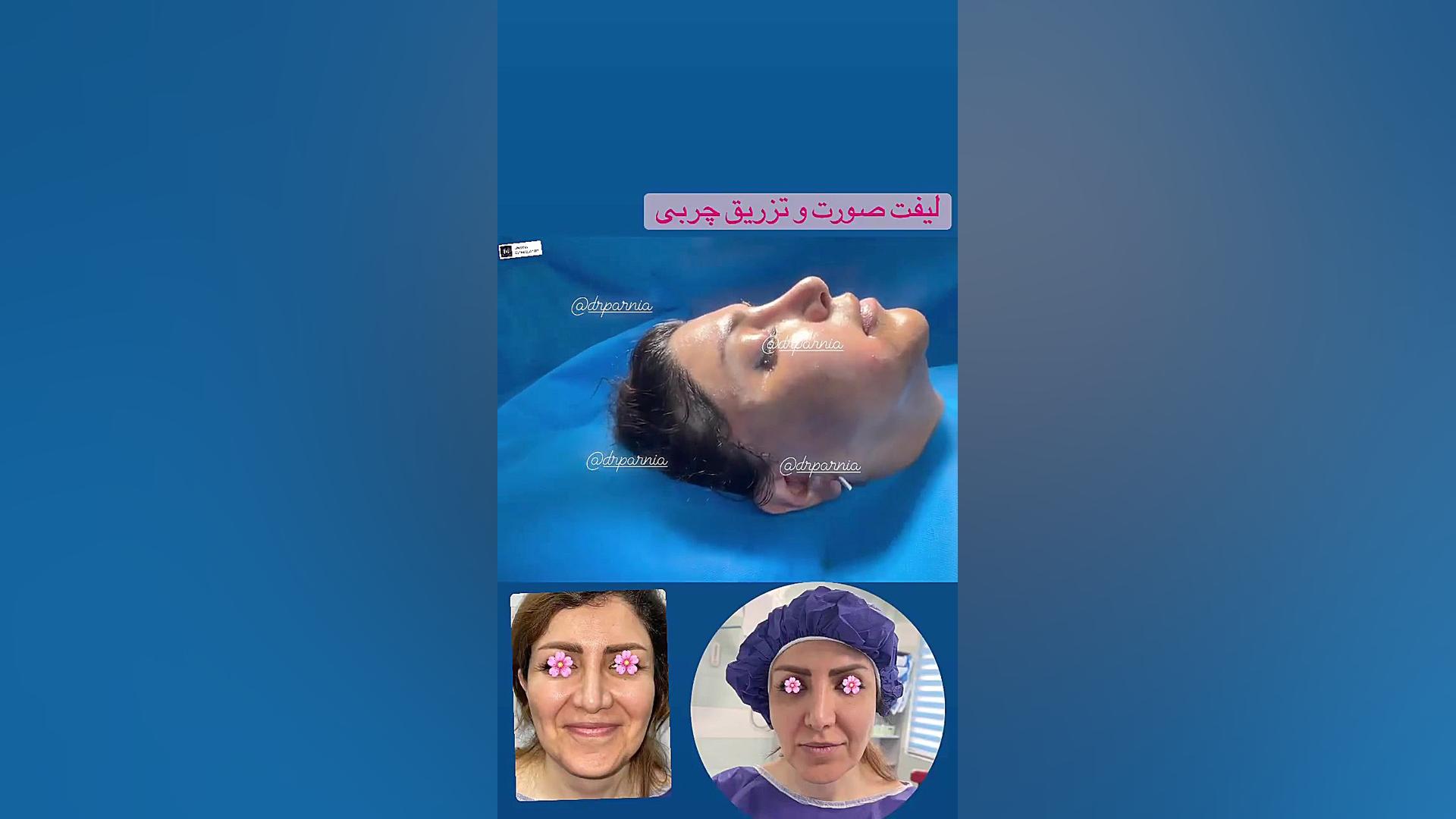 لیفت صورت و تزریق چربی پرمترکسد