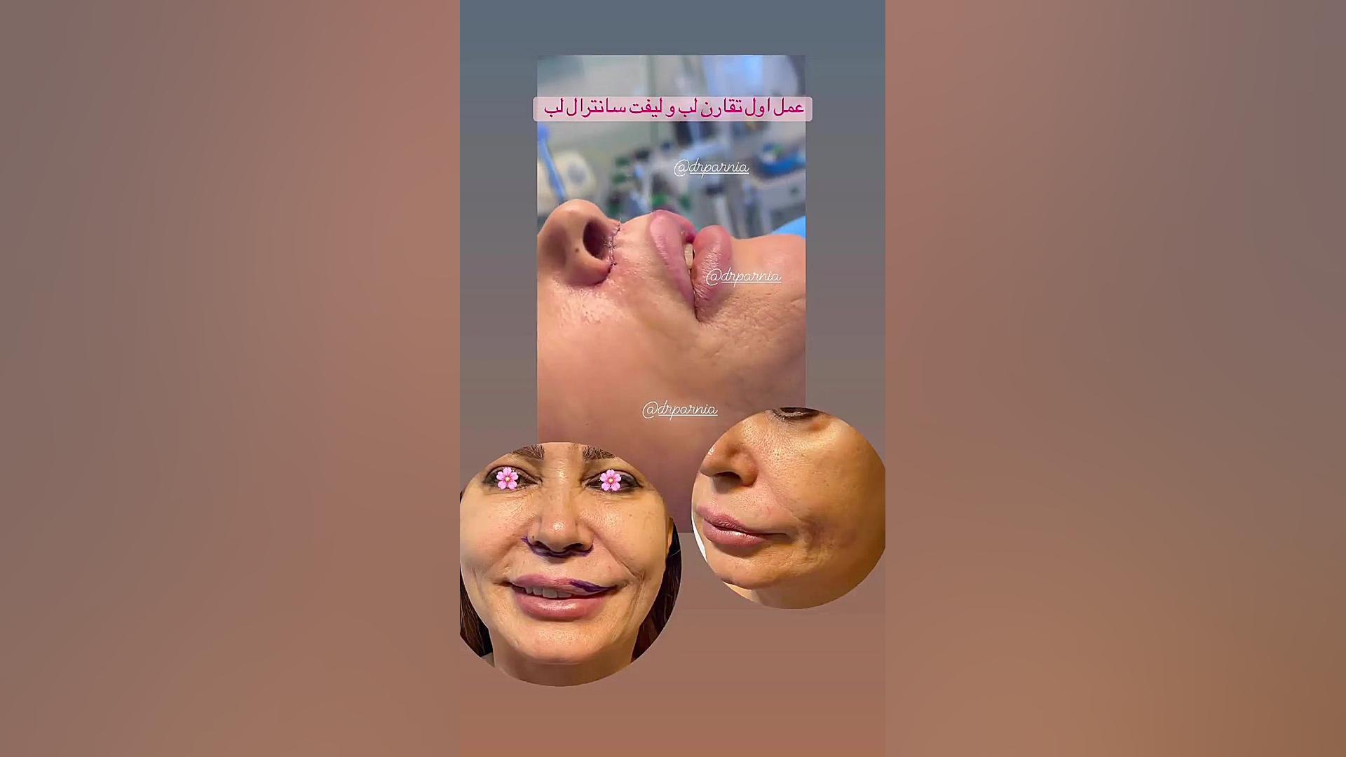 تزریق ژل لب دکتر رفیع پرنیا فوق تخصص پلاستیک