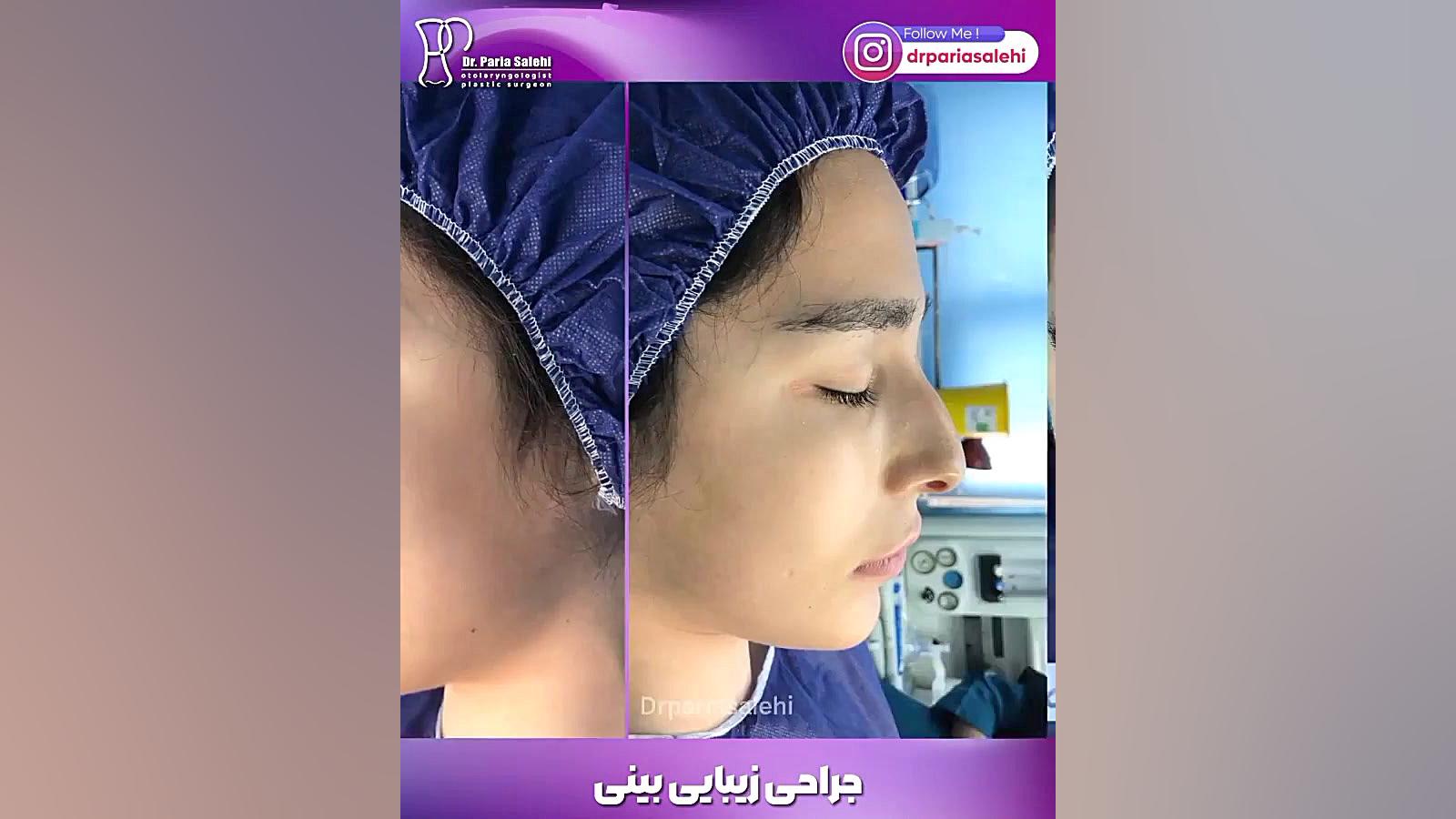 جراحی زیبایی بینی دکتر پریا صالحی ✔ بهترین جراح بینی تهران