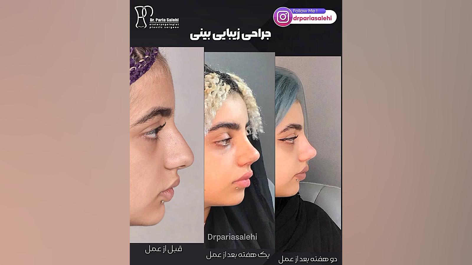 جراحی بینی نیمه فانتزی دکتر پریا صالحی ✔ بهترین جراح بینی تهران
