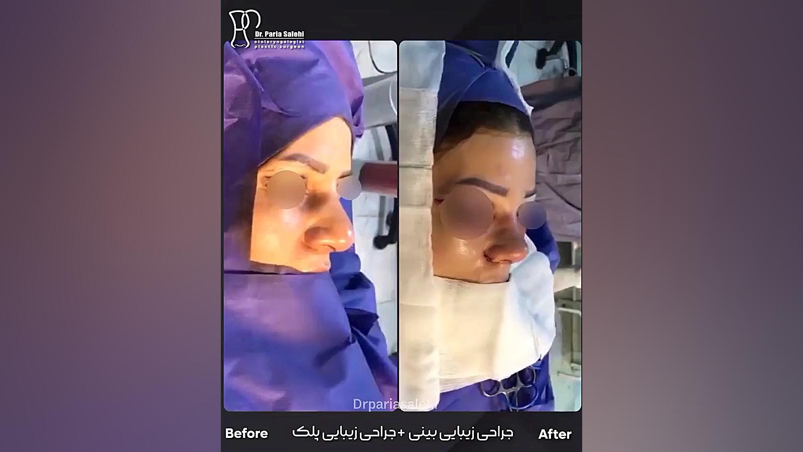 ویدیو نمونه کار جراحی بینی دکتر صالحی دکتر پریا صالحی ✔ بهترین جراح بینی تهران