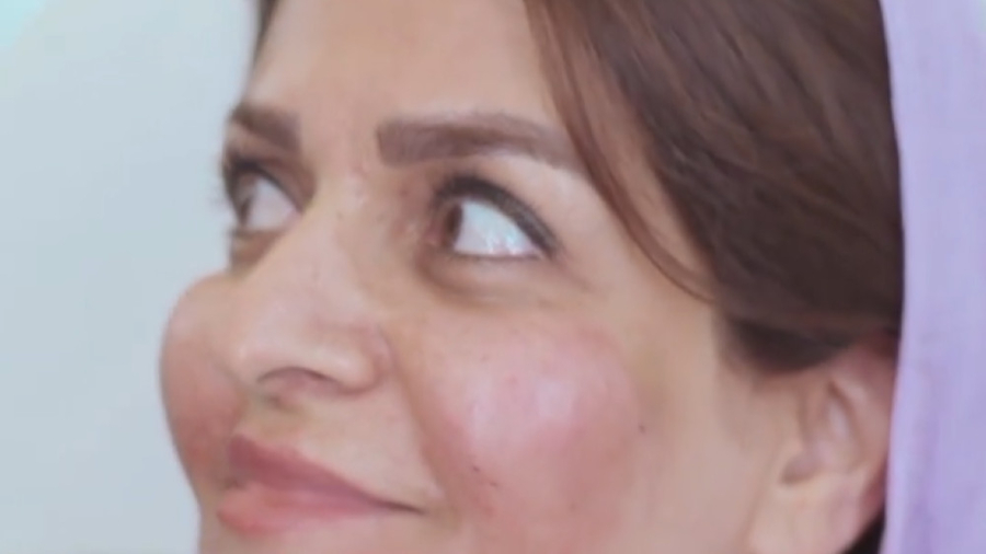 تزریق چربی صورت دکتر سوسن احمدی پیر شهید