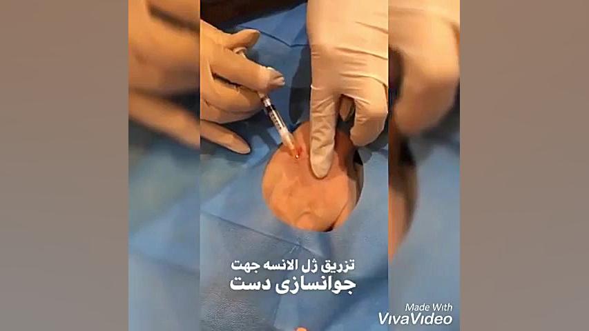 تزریق ژل به پشت دست برای جوانسازی پوست کلینیک زیبایی