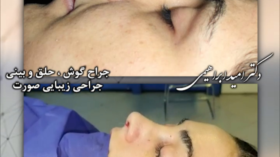جراحی بینی طبیعی زنانه و برطرف کردن قوز و کجی بینی توسط دکتر امید ابراهیمی دکتر امید ابراهیمی