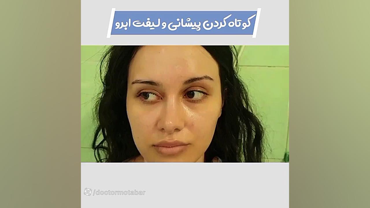 کوتاه کردن پیشانی به همراه لیفت ابرو‌ دندانپزشک زیبایی