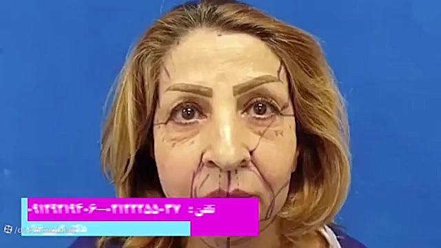 لیفت کامل صورت و گردن و لیفت آندوسکوپی ابرو و شقیقه و تزریق نانوفت صورت ایمونولوژی محاسباتی