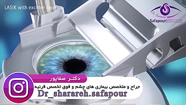 انیمیشنی در خصوص جراحی لیزیک چشم دکتر شراره صفاپور