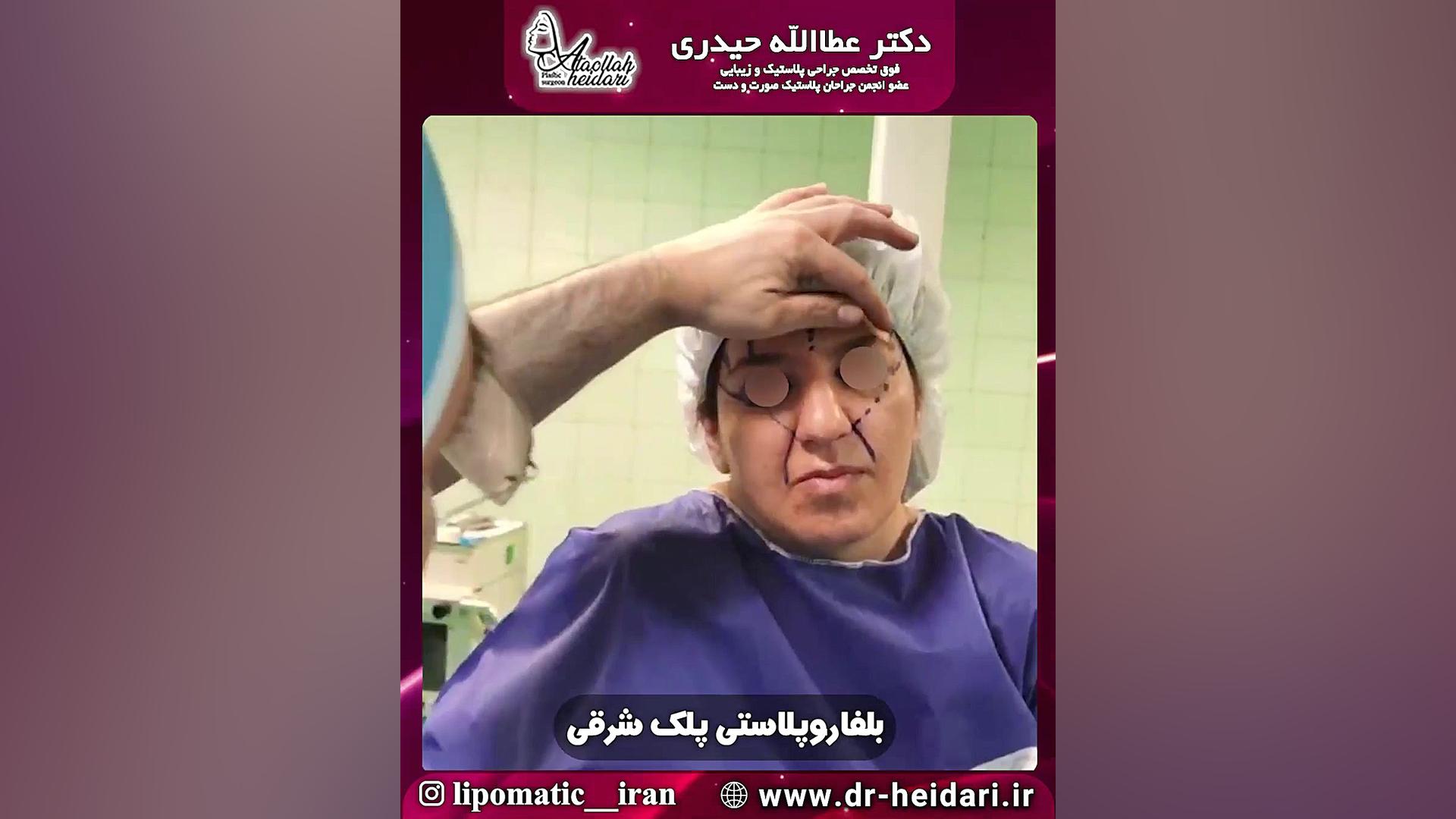 لیفت آندوسکوپی پیشانی و بلفاروپلاستی پلک شرقی بیماری استئوجنز ایمپرفکتا