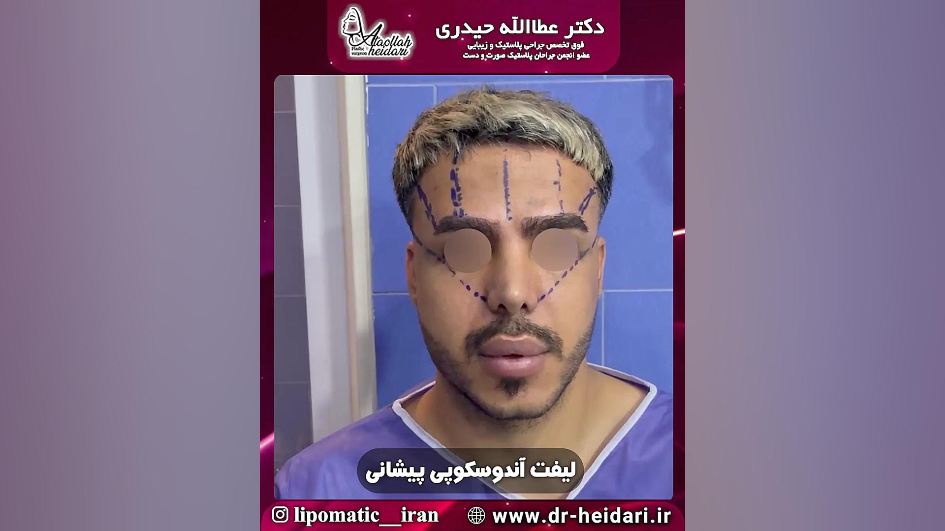 لیفت آندوسکوپی پیشانی FEV1