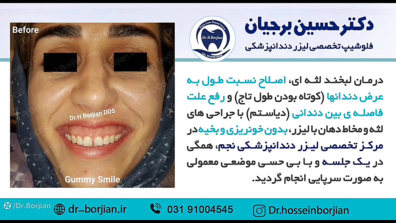 نمونه درمان لبخند لثه ای با جراحی با لیزر | بهترین جراح لثه اصفهان آکنه