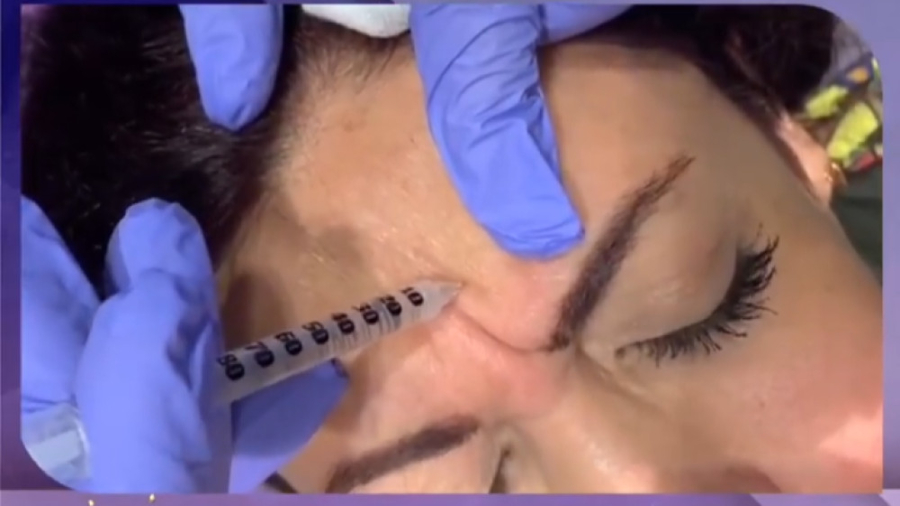 فیلم تزریق بوتاکس به پیشانی Microarray