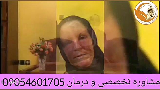 مشاوره و درمان قطعی لوپوس لیزر فرکشنال