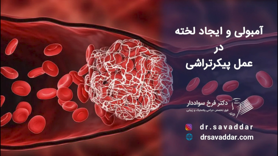 آمبولی و ایجاد لخته در عمل پیکر تراشی جراحی پف زیر چشم
