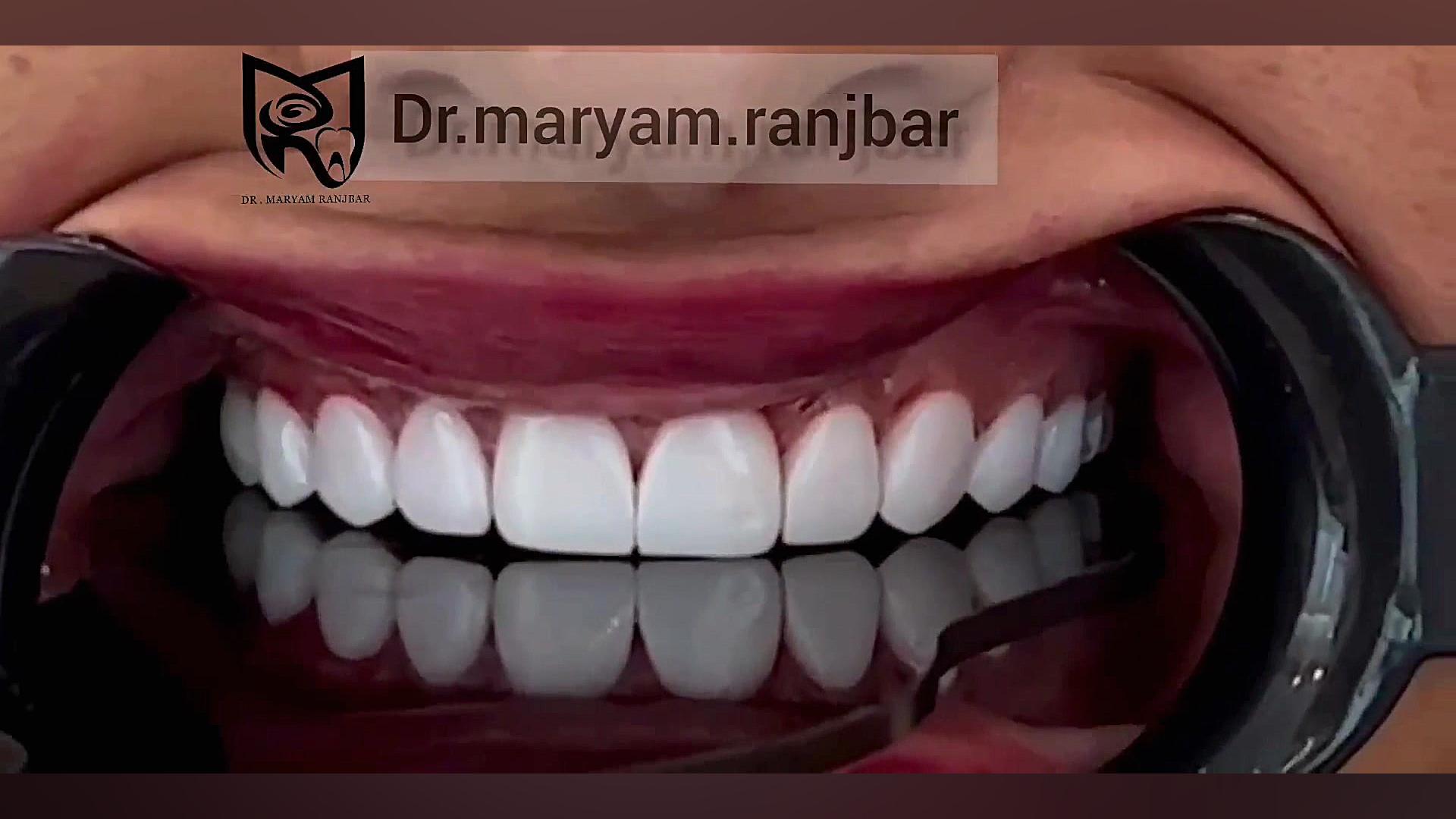 کامپوزیت ونیر- دکترمریم رنجبر کاشت ریش