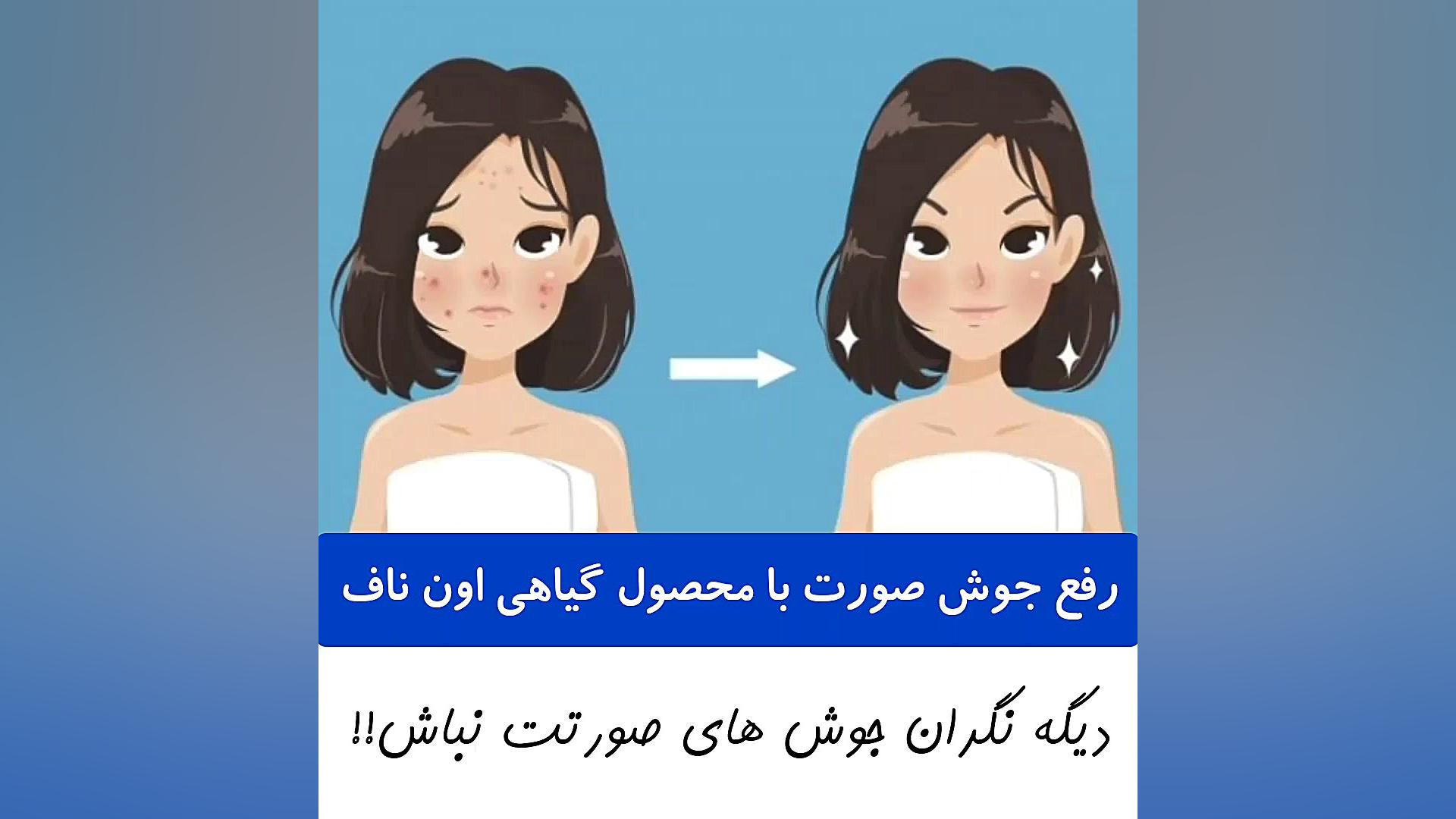 جدیدترین دارو برای ازبین بردن جوش های سرسیاه 09120132883 پوسیدگی دندان