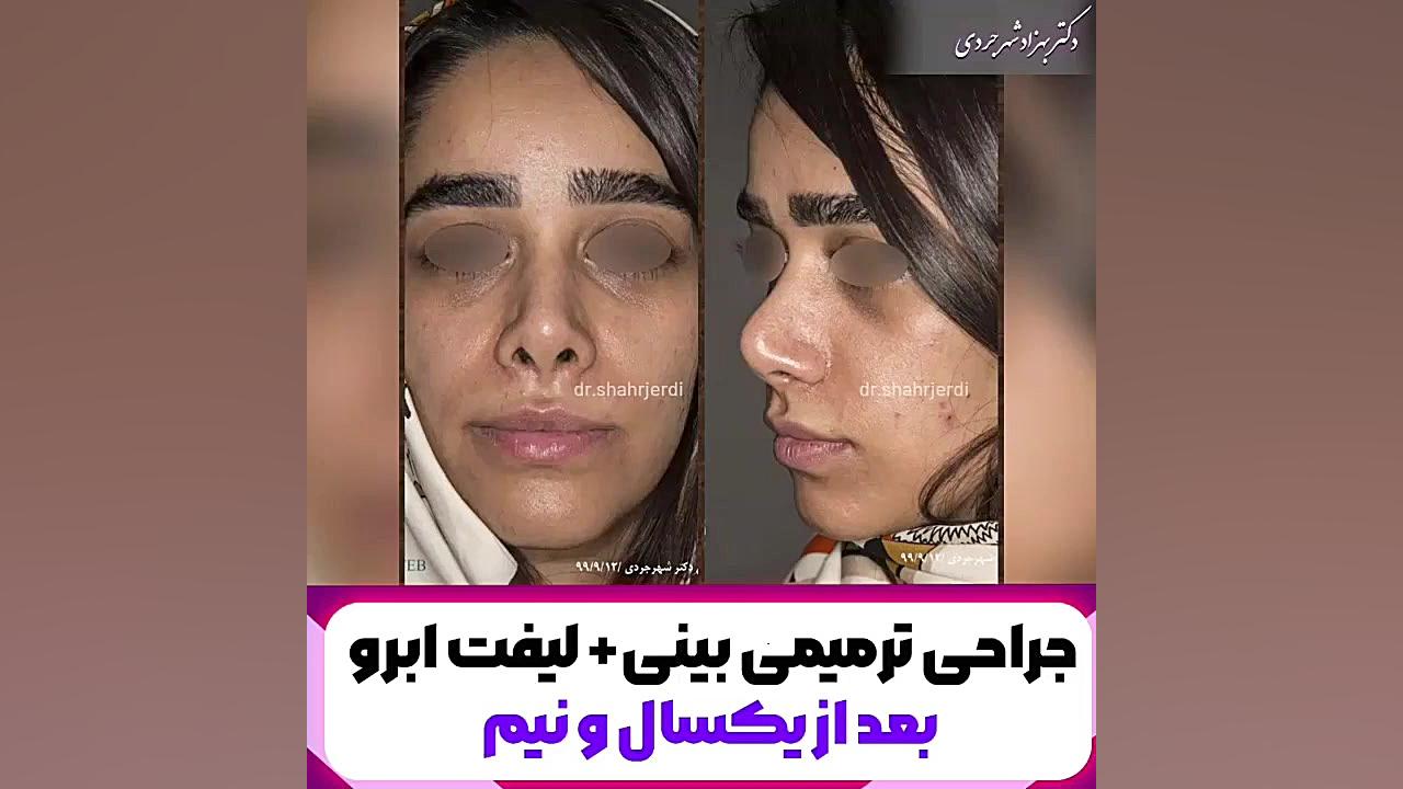 جراحی ترمیمی بینی و لیفت ابرو رفع غبغب