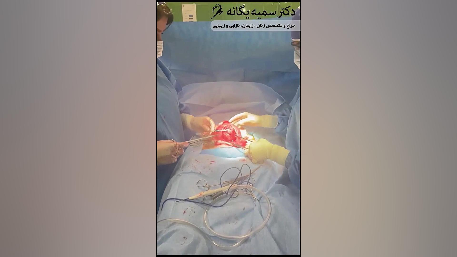 خارج کردن فیبروم 9 سانتی متری جراحی فک