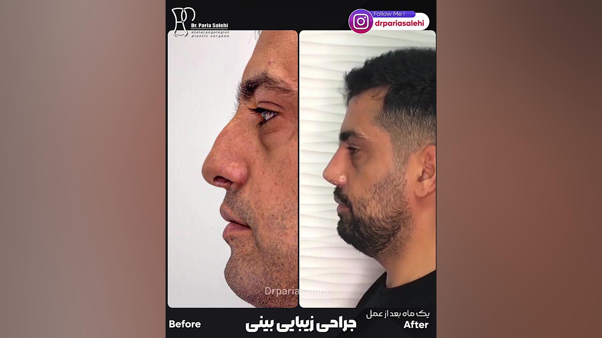 جراحی بینی مردانه دکتر پریا صالحی ✔ بهترین جراح بینی تهران