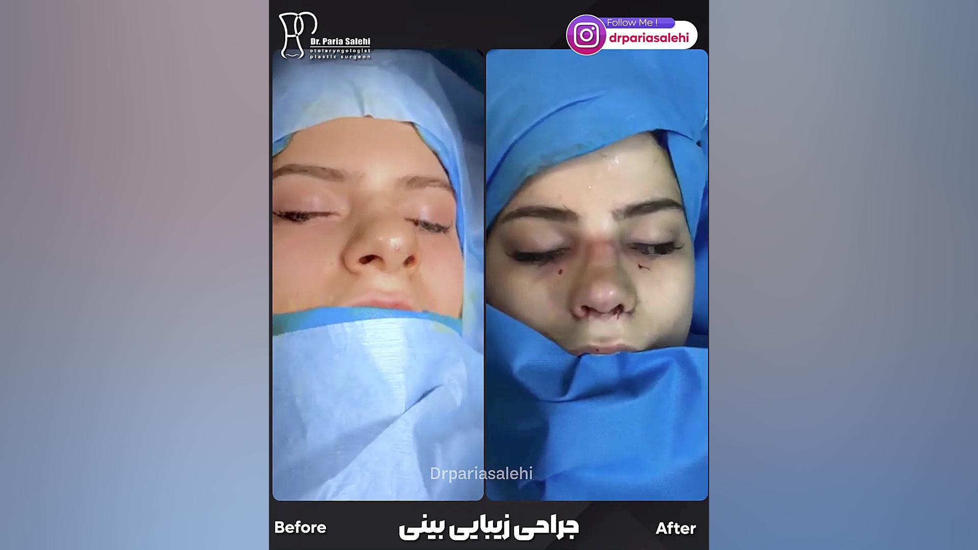 جراحی بینی استخوانی دکتر پریا صالحی ✔ بهترین جراح بینی تهران