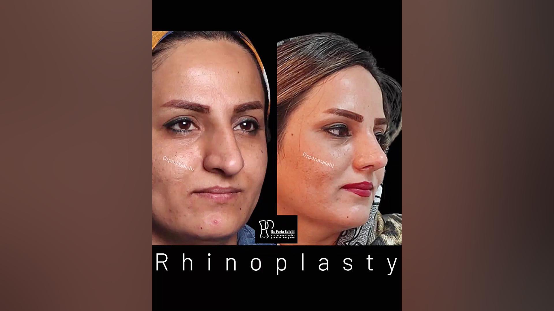جراحی زیبایی بینی در تهران دکتر پریا صالحی ✔ بهترین جراح بینی تهران