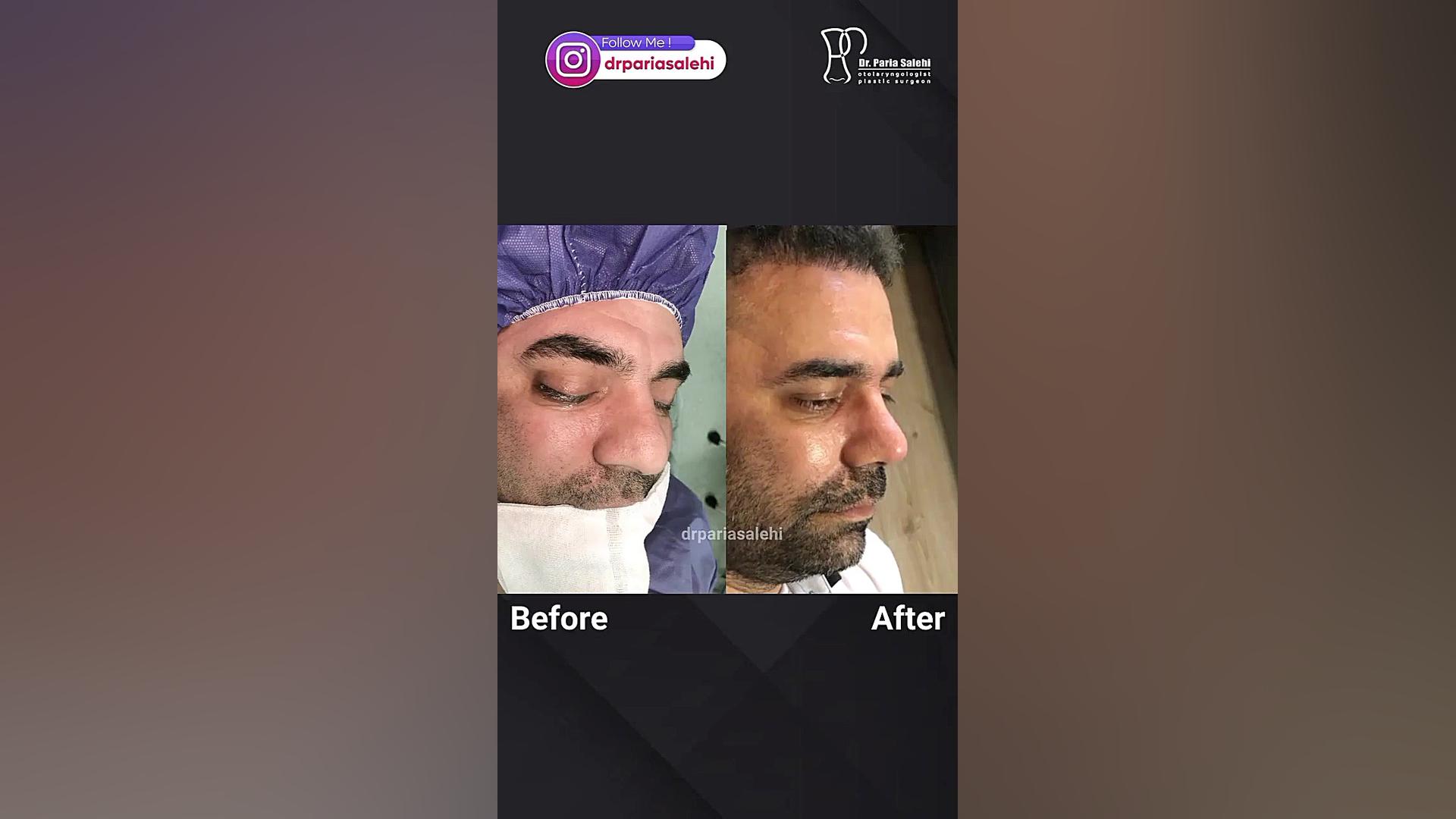 جراحی بینی گوشتی در تهران دکتر پریا صالحی ✔ بهترین جراح بینی تهران